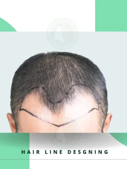 A well-designed hairline is the key to a natural-looking transplant. This image shows a soft, slightly irregular hairline being drawn, which mimics natural hair growth patterns.