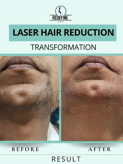 This before and after shows the result of laser hair reduction on the chin area for a male client. The treatment effectively reduces coarse stubble, leading to smoother skin and less shaving irritation.