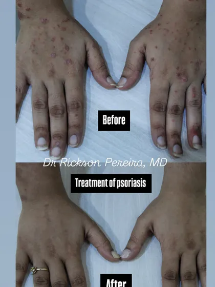 Psoriasis on the hands can be particularly challenging for daily activities. This result shows a complete clearance, restoring comfort and function. Modern treatments offer hope for even the most persistent forms of psoriasis.
