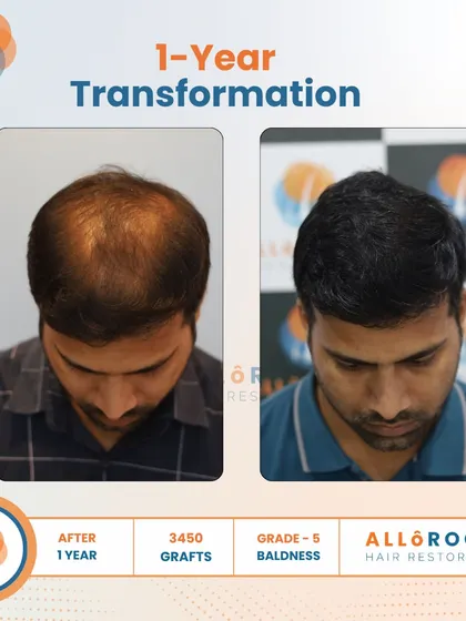 This is a one-year transformation for a Grade 5 baldness case, achieved with 3450 grafts. The before and after photos from various angles show a comprehensive restoration of the scalp, resulting in a full and natural look.