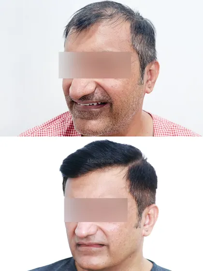 A split-image comparison showing the transformation from two different angles, highlighting both the hairline reconstruction and the overall increase in volume.