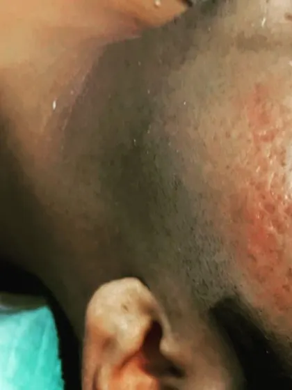 A close up view of a patient's cheek with atrophic acne scars before a PRP session. This treatment is highly effective for improving skin texture and reducing the depth of such scars.