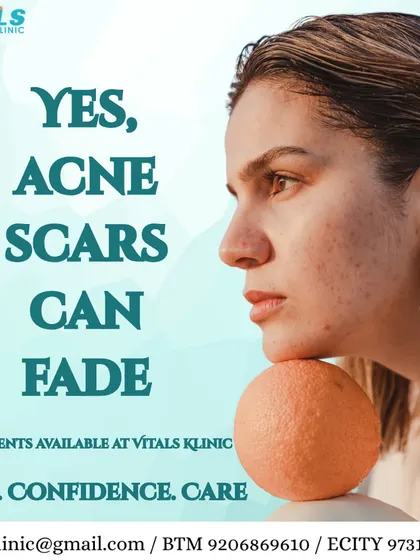 The message here is one of hope: acne scars are not permanent. With the right treatments, such as microneedling or laser resurfacing, we can significantly fade these marks and restore a smoother skin surface.