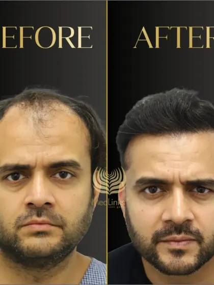 This before and after comparison shows a remarkable change. The patient's confidence is visibly boosted by the full, natural-looking hairline we created for him.