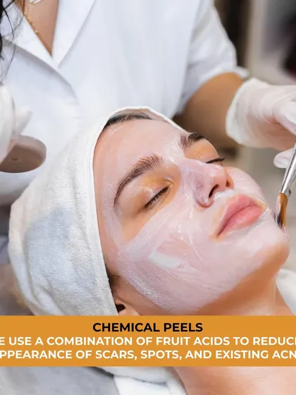 A client receiving a chemical peel. We use a combination of fruit acids and other medical-grade ingredients to reduce the appearance of scars, spots, and existing acne.