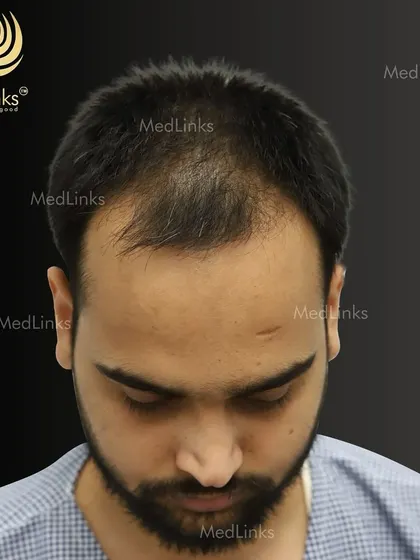 A receding hairline and thinning at the front can be a major concern. This before photo shows the extent of hair loss before we began our treatment.
