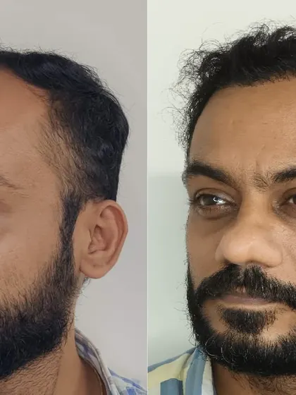 This three-quarter view further showcases the comprehensive coverage and the natural angle of the transplanted hair grafts.