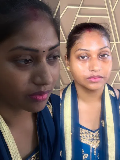 This before and after shows how my Korean treatment effectively tackled hyperpigmentation and dark spots around the eyes and cheeks. The result is clearer, brighter, and more luminous skin.