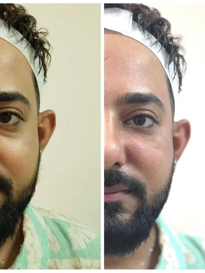 This client's under-eye area was treated for hollowness and fatigue. The after photo shows a plumper, more rejuvenated look, achieved through our personalized treatment plan.