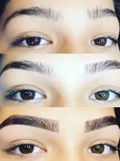 This front-on view clearly shows the dramatic yet natural transformation possible with microblading. From sparse and undefined to full and perfectly shaped, this treatment makes a huge difference.