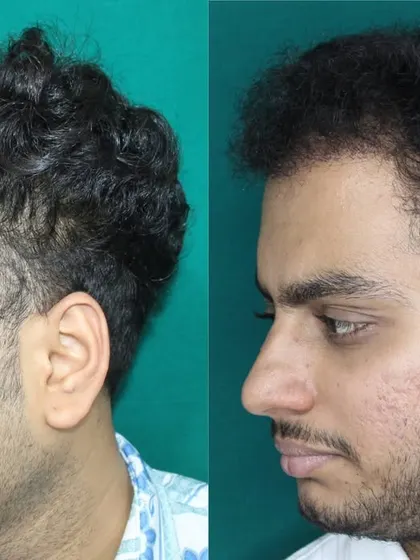 This profile view demonstrates how the new hairline seamlessly connects to the temporal points. This is a key detail for ensuring the hair transplant looks natural from all sides, not just from the front.