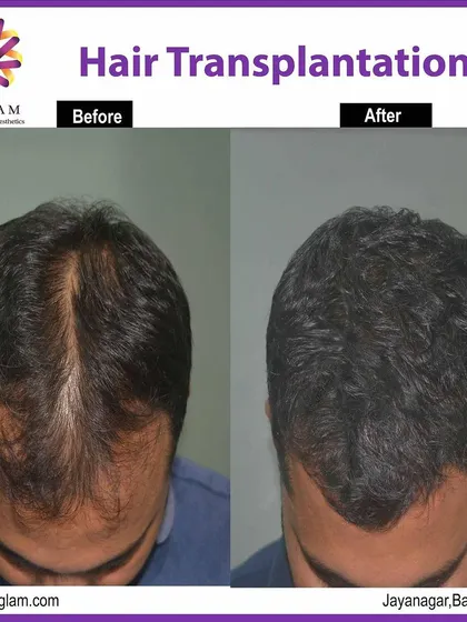A top-down view showcasing the remarkable results of our hair transplant procedure. We successfully filled in the thinning crown area, achieving a full and youthful appearance.
