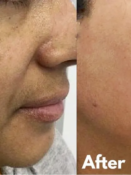 A powerful before-and-after of melasma treatment. The "after" photo shows not just lighter skin, but a complete restoration of an even, healthy complexion, which has a huge impact on a person's confidence.