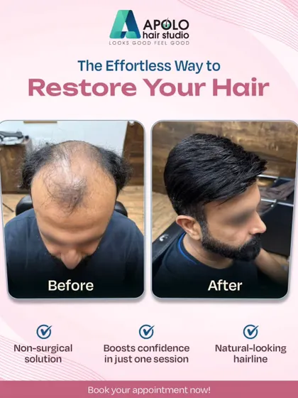 In just one session, we helped this client boost his confidence with a non-surgical hair patch. The result is a natural-looking hairline and a full head of hair.