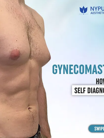 This guide explains how to self-diagnose gynecomastia. Understanding the symptoms is the first step toward finding the right solution for a more masculine chest contour.