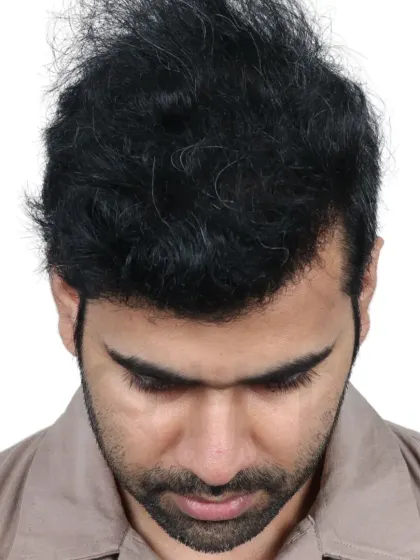 A 14-month transformation for a Diffuse Grade 5A case. We used 4200 grafts to recreate the hairline and re-densify the frontal and mid-scalp.