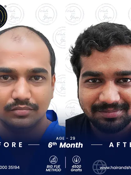 The frontal view at 6 months shows a dramatic change, restoring the patient's hairline and confidence with the BIG FUE technique.