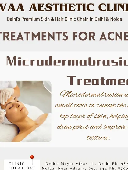 An introduction to Microdermabrasion, a treatment that exfoliates the top layer of dead skin to clean pores and refine skin texture, making it an effective option for managing acne.