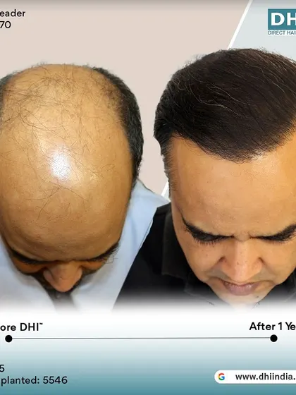 A top-down view of the one-year transformation. This image clearly shows the significant improvement in coverage and density across the scalp, demonstrating the effectiveness of our DHI procedure.
