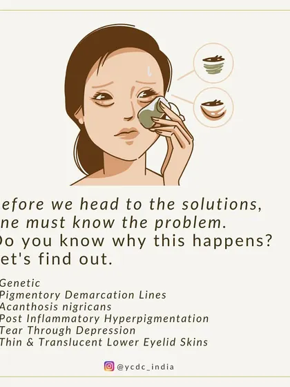 To find the right solution for dark circles, we first diagnose the cause. It could be genetic, pigmentary, or related to the thin skin under the eyes.