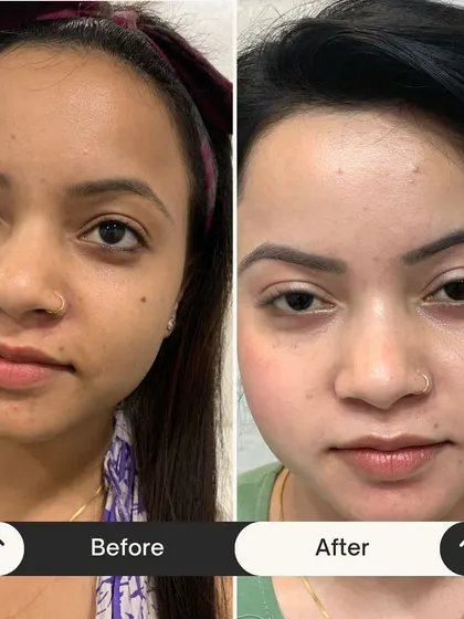 Witness the power of my Miracle Facial in just one session. This before and after shows a dramatic improvement in skin clarity, texture, and overall radiance. My goal is to give you skin that feels so good, you need less makeup to feel confident.
