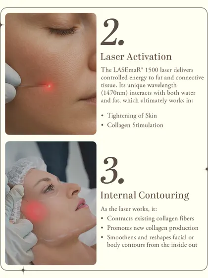 Once the fiber is in place, the laser is activated. Its unique wavelength interacts with both water and fat in the tissue, causing immediate skin tightening and stimulating new collagen production. This internal contouring reshapes the area from within.