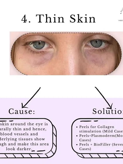Problem: Thin Skin. The skin around the eye is naturally thin, allowing blood vessels to show through. We can address this with collagen-stimulating peels, PlasmoDerm, or BioFiller to thicken and strengthen the skin.
