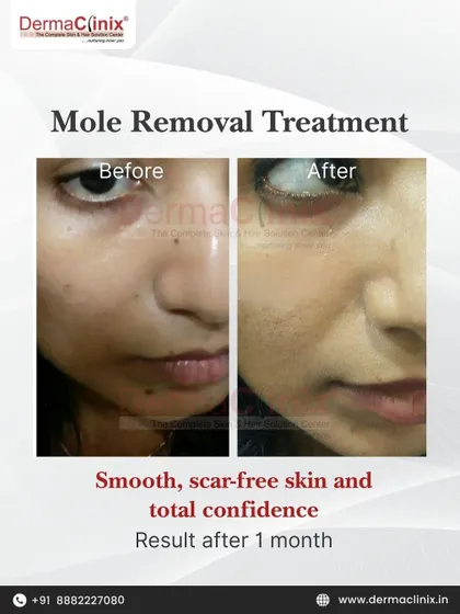 Another example of our successful mole removal treatment, showing a clear result just one month after the procedure. We focus on achieving smooth, scar-free skin to restore total confidence.
