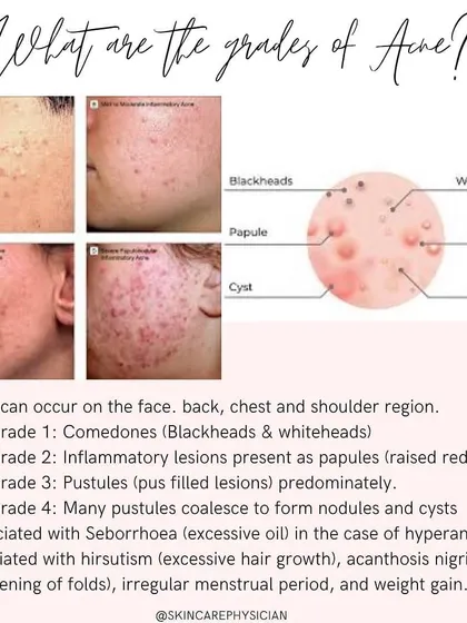 Understanding the different grades of acne, from comedones to cysts, is the first step in creating an effective treatment plan. This chart helps identify the severity of acne to determine the right course of action.