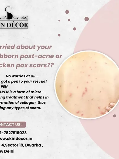 For stubborn post-acne marks or even chicken pox scars, the Dermapen is a fantastic solution. This microneedling device creates controlled micro-injuries in the skin, which stimulates the natural production of collagen and helps significantly reduce the appearance of various types of scars over time.