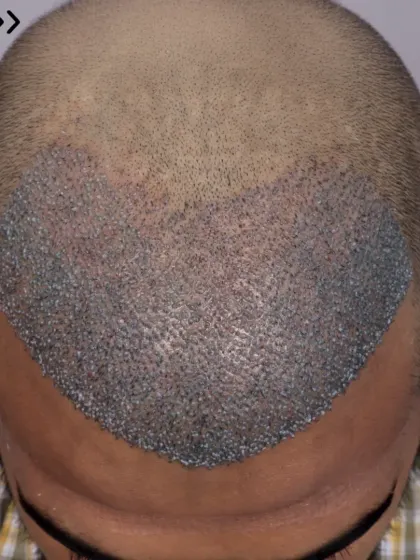 The beginning of a transformation for a Diffuse Grade 4a patient. 3400 grafts were placed to recreate the hairline and restore the frontal and mid-scalp.