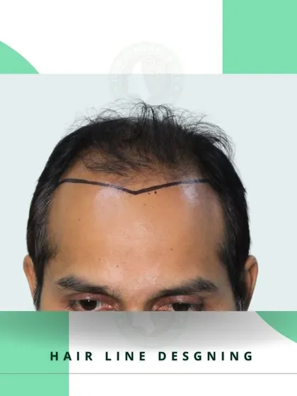 A crucial step in any hair transplant is the hairline design. This image shows a meticulously drawn V-shaped hairline, customized to create a natural and youthful appearance for the client.