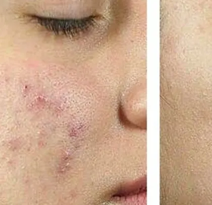 This before-and-after showcases the successful treatment of post-inflammatory erythema (persistent redness) and atrophic scars. Using a combination of therapies, we were able to even out the skin tone and smooth its texture.