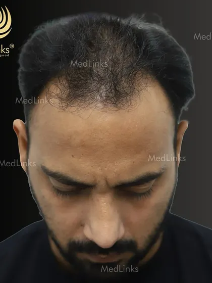 A top-down view of the patient's hair loss before the transplant.