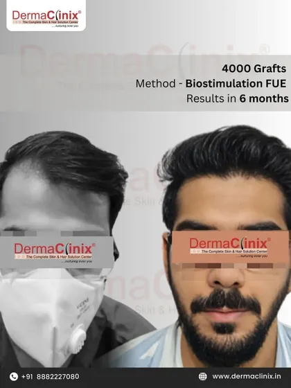 This before and after shows a 4000 graft Biostimulation FUE transplant result after only six months. The biostimulation technique helps to accelerate growth for faster, more visible results.