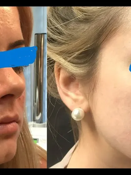 This before-and-after demonstrates the effectiveness of Microneedling with Radiofrequency (MNRF) on acne scars. The treatment delivers energy deep into the skin to remodel collagen and visibly reduce the depth of scars.