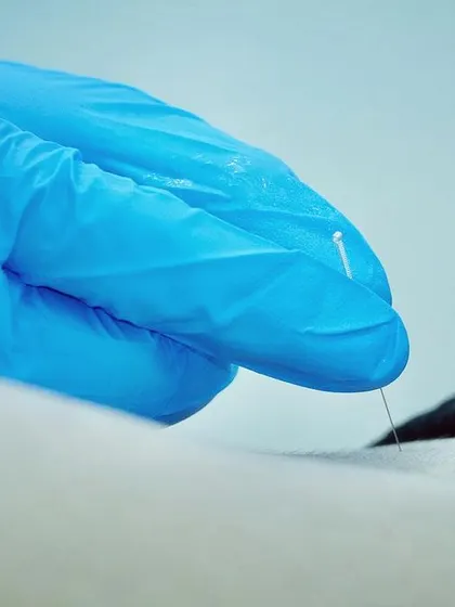 The precise application of a dry needle into a trigger point. Our therapists are highly skilled in this advanced technique to ensure it is both safe and effective for pain relief.