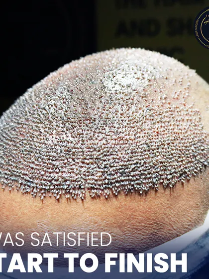 This is where science meets style. A detailed view of newly implanted hair follicles, showcasing the meticulous process of high-density hair restoration.