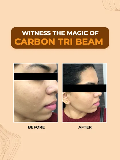 The result of our Carbon Tri-Beam laser treatment. Notice the significant improvement in skin texture, reduction in active acne, and fading of post-inflammatory hyperpigmentation.