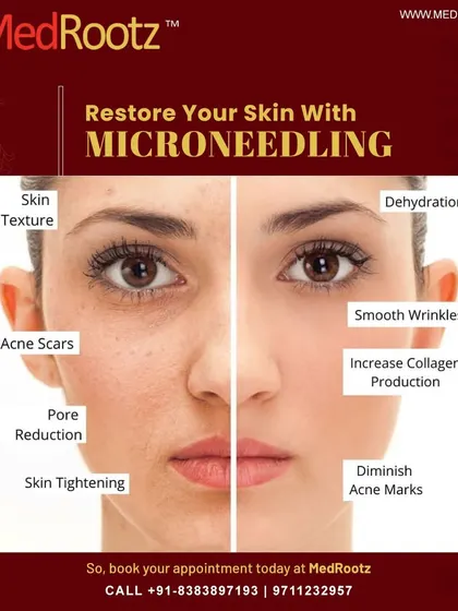 Microneedling is a powerful procedure for overall skin restoration. As this graphic shows, it helps improve skin texture, reduce pore size, diminish acne marks, and stimulate collagen for tighter, smoother skin.