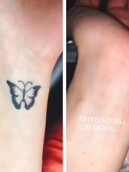This is another example of a butterfly tattoo, this one a solid black silhouette on the wrist, which has been completely cleared after laser removal sessions.