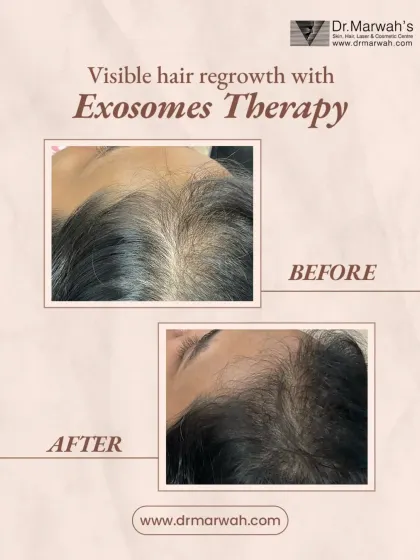 Another successful result from Exosomes Therapy, this time focusing on the frontal hairline. Notice the increase in finer, new hairs and overall thickness, which helps frame the face more softly.