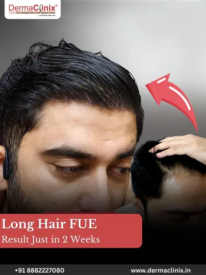 This image shows the result of a Long Hair FUE just two weeks after the procedure. The patient can walk out with confidence, as there is no trimming, no shaving, and no downtime required.