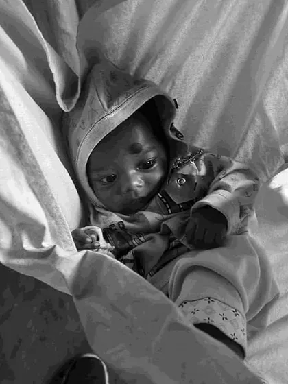 A close-up of a baby at a Nutrition Rehabilitation Centre. The exhibition did not shy away from showing the harsh realities of severe acute malnutrition to raise awareness.