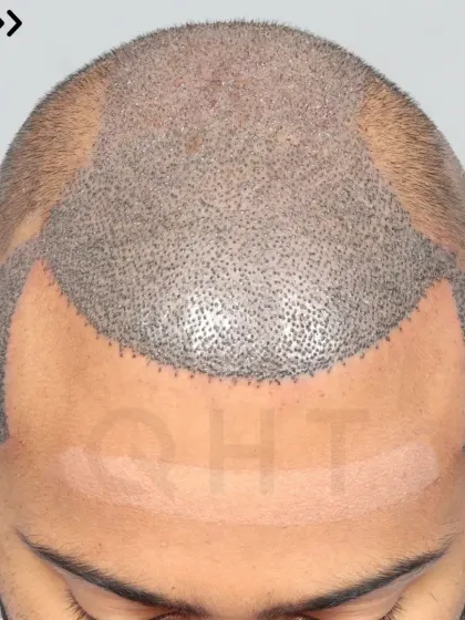A Norwood Grade 6 transformation in progress. 5900 grafts were placed to recreate the hairline, frontal part, mid-scalp, crown, and temples.
