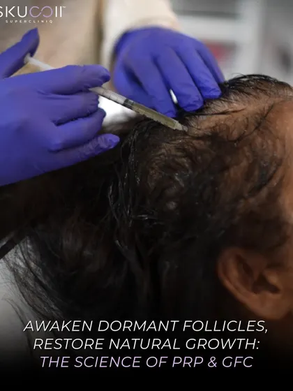Here, we are performing a PRP & GFC treatment, injecting a concentration of the client's own growth factors directly into the scalp. This procedure is designed to restore natural growth by stimulating inactive follicles.