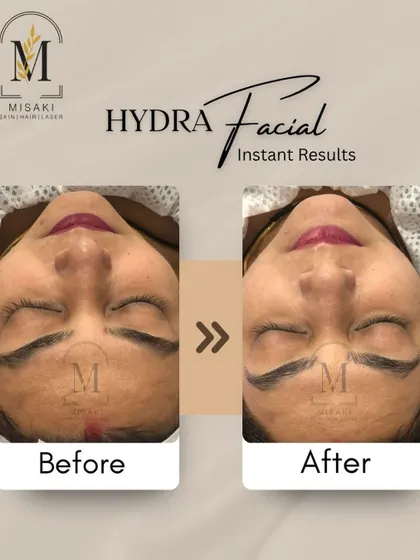 A clear before and after comparison showing the instant brightening and clarifying results of a single HydraFacial session.