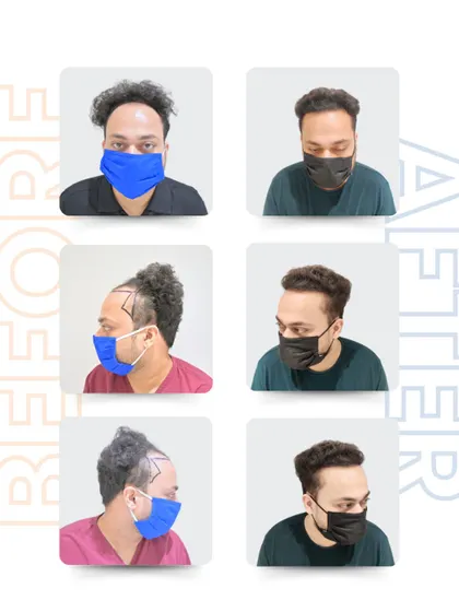 Here is Anurag’s transformation from all angles. The 3,000 grafts placed with the Sapphire Blade technique resulted in a remarkably natural and dense hairline, showcasing the precision of this advanced method.