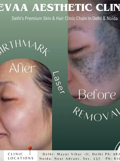 A powerful before and after of a laser birthmark removal procedure. Our specialized lasers target and break down pigmented lesions, significantly lightening the birthmark and evening out the skin tone for a renewed appearance.