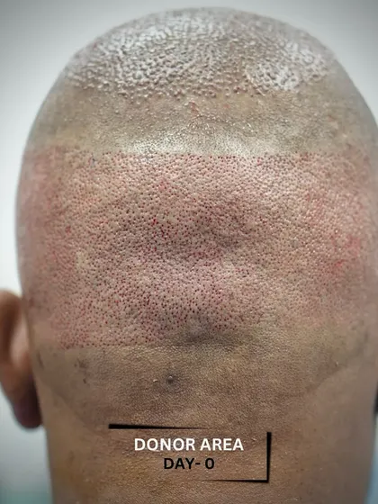 The donor area on day zero of a 3500-graft transplant. The redness is minimal and subsides quickly, and the extraction points are small to ensure fast, discreet healing.